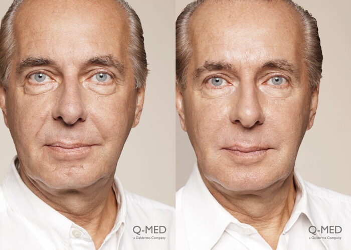 Full face filler with cheek enhancement 2 weeks post treatment