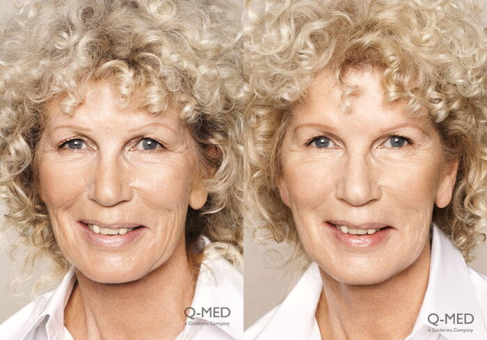 Full face filler with cheek enhancement 2 weeks post treatment