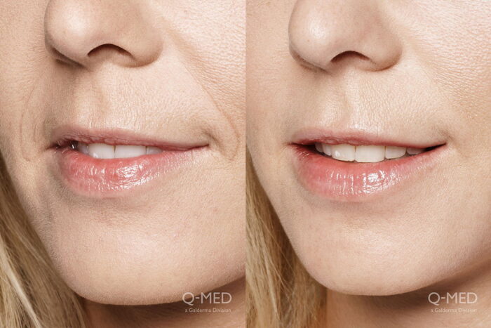 Fuller looking lips with injectable dermal fillers 2 weeks post treatment