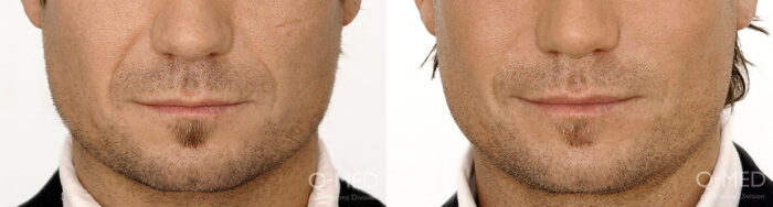 Appearance of lines near mouth reduced with injectable dermal fillers 2 weeks post treatment