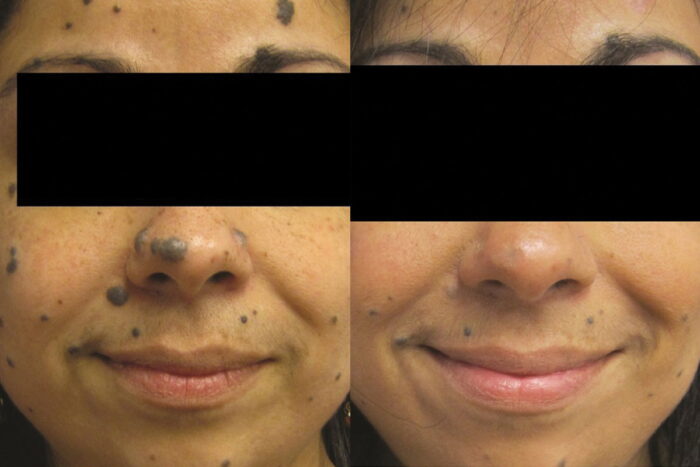 1-2 treatments to remove nuisance lumps and bumps and annoying moles