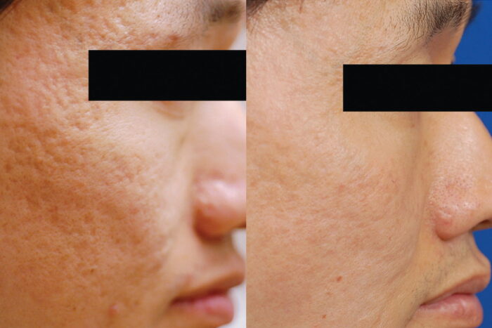 Reduce acne scarring and other scarring with 3 or more treatments