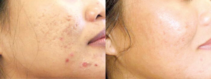 Reduce acne scarring and other scarring with 3 or more treatments