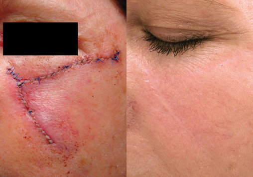Reduces scarring with 2 or more treatments