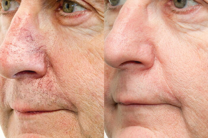 Treatment of broken capillaries and facial redness with 3-5 treatments