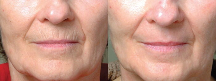 Softens wrinkles and removes the signs of excessive ageing with 4-7 days downtime depending on the treatment type