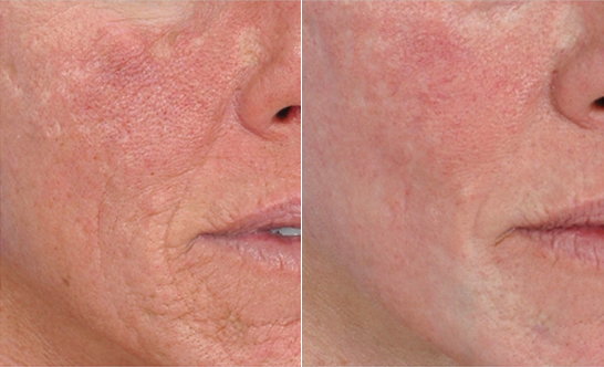 Reduce acne scarring and other scarring with 1-2 treatments