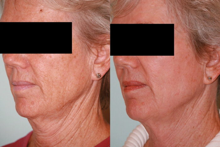 Treat a common set of problems (brown marks, wrinkles and sagging skin) with our multiplatform laser using 3 different modalities in the one session