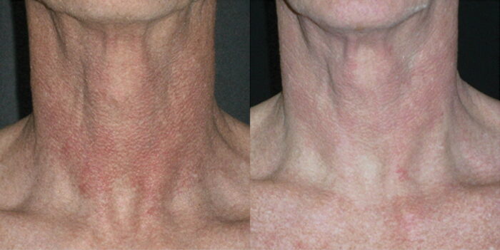 Removal of brown 'liver spots' with a course of 2-3 treatments