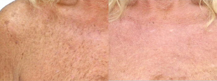 Removal of brown 'liver spots' with a course of 2-3 treatments