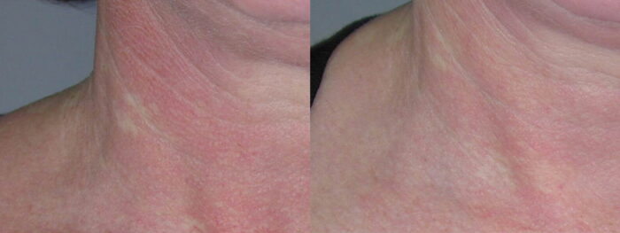 Treatment of broken capillaries and facial redness with 3-5 treatments