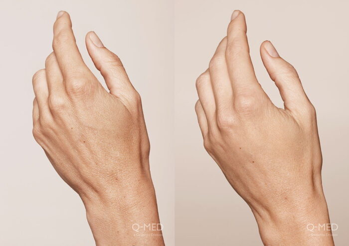 Younger looking hands with injectable dermal fillers 2 weeks post treatment