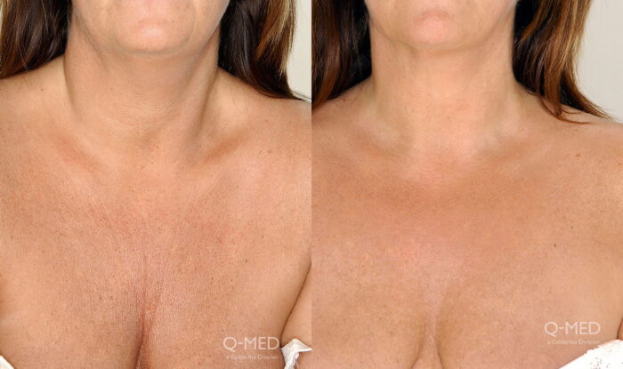 Appearance of wrinkled decolletage reduced with injectable dermal filler 2 weeks post treatment
