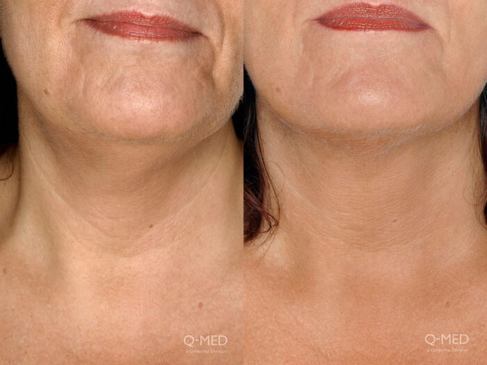 Appearance of neck lines reduced with injectable dermal filler 2 weeks post treatment
