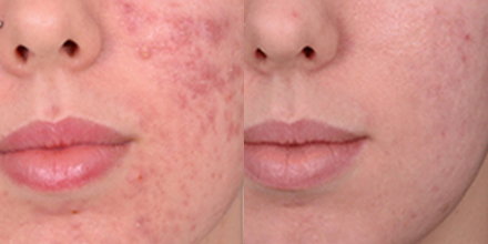 Reduce acne scarring and other scarring with 1 treatment